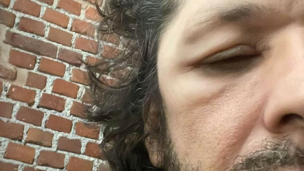 Ermal Meta preoccupa i fans: “Mi si gonfiano parti del viso e della testa” – FOTO SHOCK