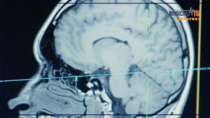 Tecnologia all’avanguardia: ultrasuoni focalizzati per la neurochirurgia