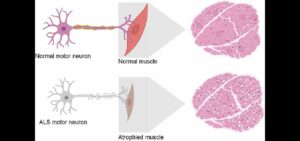 Lezione di Carlotta Ferlito: Cos’è la SLA, una malattia debilitante che colpisce i muscoli