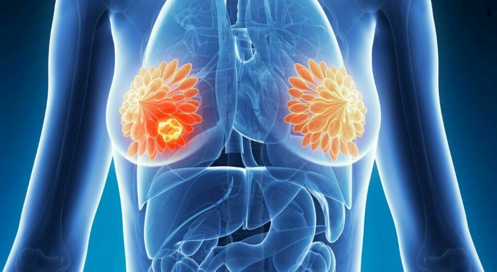 Più di due pazienti su tre con tumore al seno Her2 positivo e metastasi cerebrali beneficiano di un anticorpo efficace che riduce le lesioni