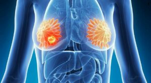 Più di due pazienti su tre con tumore al seno Her2 positivo e metastasi cerebrali beneficiano di un anticorpo efficace che riduce le lesioni