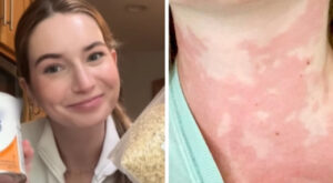 La sindrome da attivazione dei mastociti: limitata a due cibi