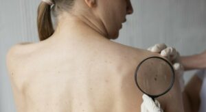 Primo test in Italia per un vaccino a mRna contro il tumore cutaneo più comune: il “Tumore del marinaio”