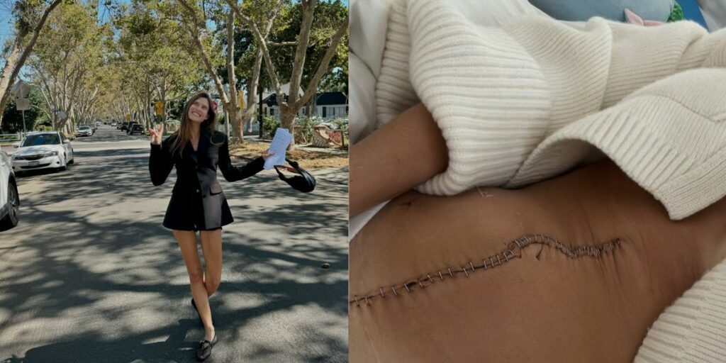 La condivisione della foto della cicatrice post-operazione di Bianca Balti per rimuovere il tumore ovarico