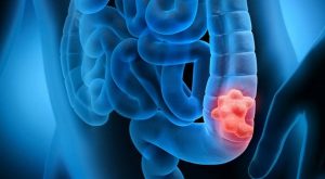 Una nuova cura per il tumore al colon-retto metastatico associa un anticorpo anti-EGFR alla...