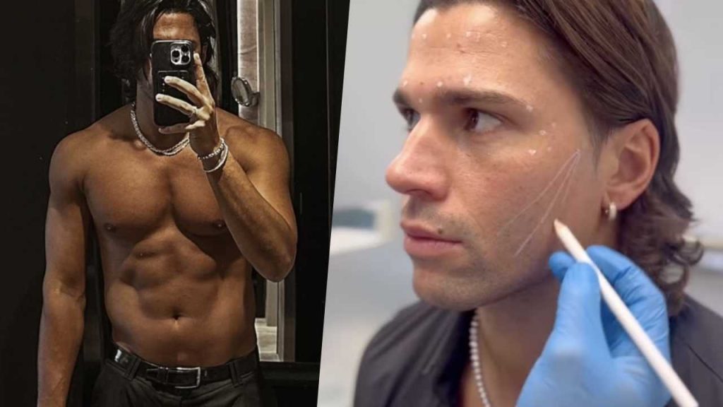 Luca Onestini si sottopone a un trattamento di filler al viso: ecco i risultati prima e dopo