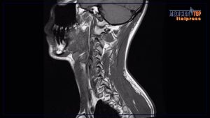 Aumento dei tumori dell’orofaringe: importanza dei segnali e dei vaccini