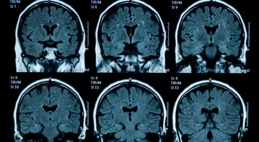 8579044_07152558_alzheimer_parkinson_traumi_testa.jpg