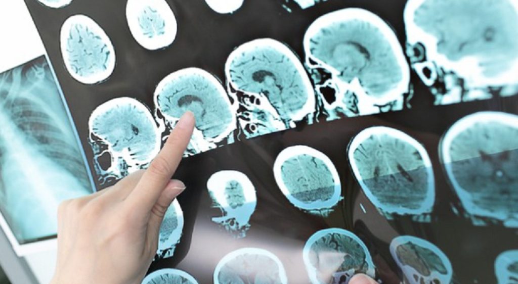 La ricerca di un gruppo italiano sulle «mutazioni genetiche rare»