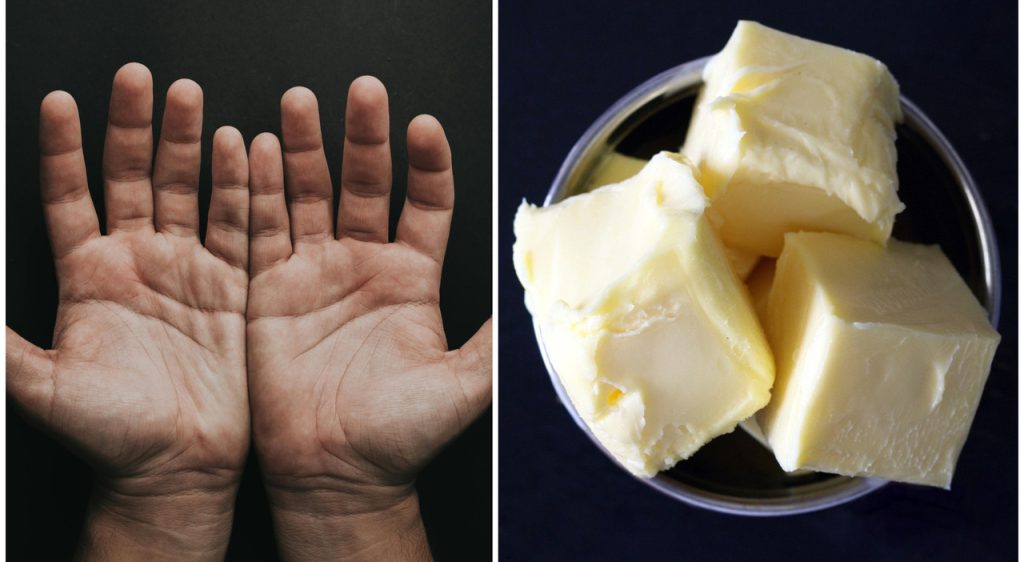 Mangio formaggio, burro e carne per otto mesi, dimagrisco e sviluppo xantelasma da sudorazione di grassi