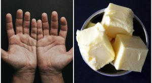 Mangio formaggio, burro e carne per otto mesi, dimagrisco e sviluppo xantelasma da sudorazione di grassi