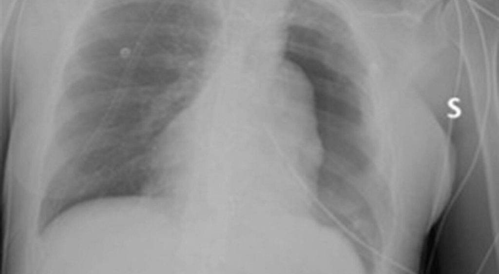 35enne supera la battaglia contro un tumore grande come un cocomero dopo il Covid: «Recupero miracoloso» al Gemelli