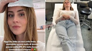 Valentina Ferragni rimuove un neo dalla testa: “Non è nulla di brutto”