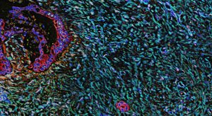 Il segreto dell’aggressività del tumore al pancreas: come evade le terapie conosciute