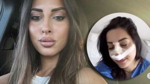 Francesca Sorrentino racconta la sua esperienza con la rinosettoplastica