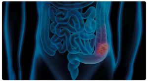 Tumore al colon: operazione da sveglia con robot e immagini 3D all'Ospedale Cristo Re di Roma - un nuovo standard di cura