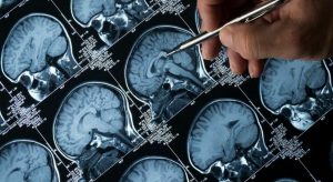 8793704_23070631_alzheimer2.jpg
