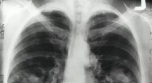 Nuova terapia mirata per il tumore al polmone: colpisce anche giovani non fumatori.