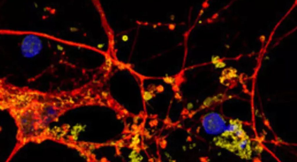 Nuove speranze nella demenza frontotemporale: il farmaco per il colesterolo potrebbe fare la differenza