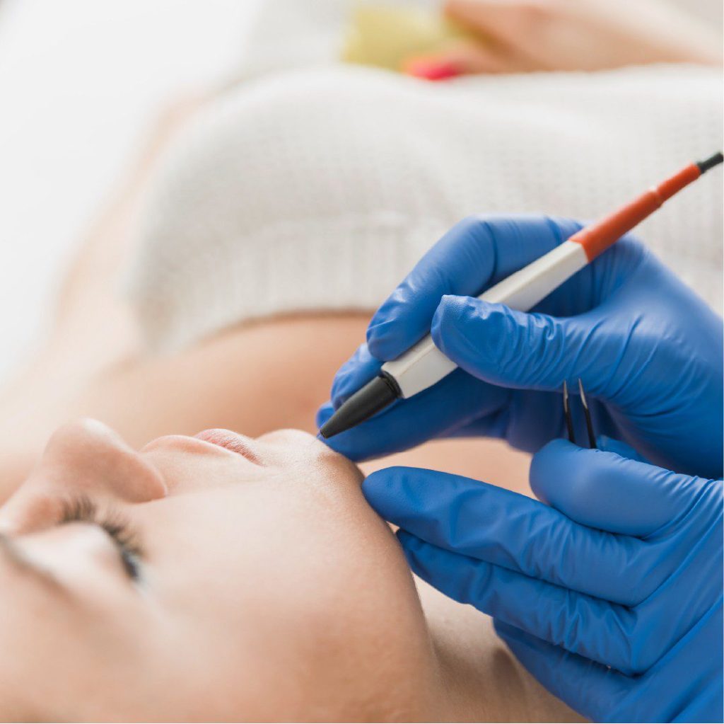 Elettrolisi: scopri come funziona la depilazione definitiva tramite questo metodo efficace.