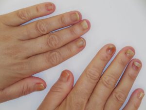 Unghie sollevate: cause di onicolisi e differenze tra acrilico e gel.