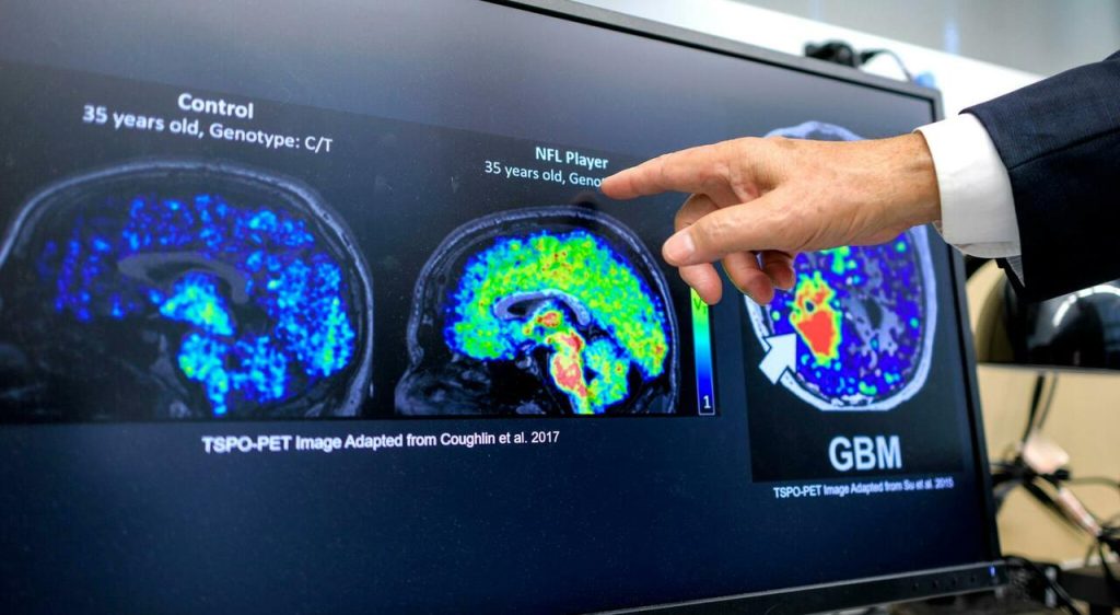 Alzheimer: l’UE approva anticorpo monoclonale di Kisunia per rallentare il declino cognitivo.