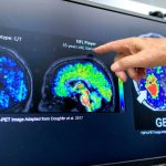 Comprendere l’Alzheimer: sintomi, cause e trattamenti per una migliore qualità della vita