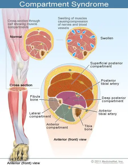 Compartment Syndrome: Cause, Sintomi, Diagnosi e Trattamento Essenziali da Conoscere