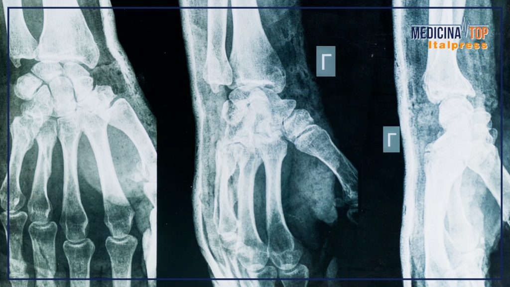 Artrite e artrosi: sintomi simili, ma cause e trattamenti distinti da conoscere.