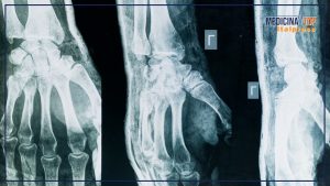 Artrite e artrosi: sintomi simili, ma cause e trattamenti distinti da conoscere.