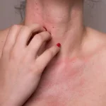 Dermatite da contatto al nichel: sintomi e trattamenti efficaci per la pelle