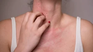 Dermatite da contatto al nichel: sintomi e trattamenti efficaci per la pelle