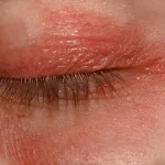 Blefarite: sintomi, cause e trattamenti per occhi infiammati e irritati