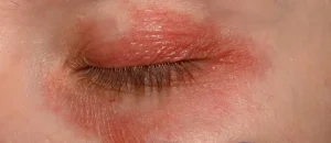 Blefarite: sintomi, cause e trattamenti per occhi infiammati e irritati
