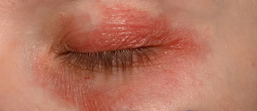 Blefarite: sintomi, cause e trattamenti per occhi infiammati e irritati