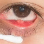 Scopri cos’è il calazio: cause, sintomi e trattamenti efficaci per gli occhi.