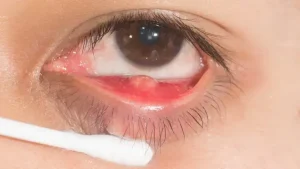 Scopri cos’è il calazio: cause, sintomi e trattamenti efficaci per gli occhi.