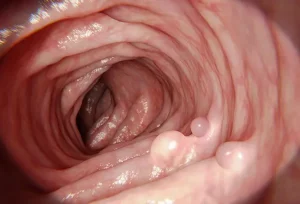 Gardner’s Syndrome: Sintomi, Cura e Prognosi Essenziale per una Vita Migliore