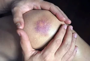 Che cos'è una contusione? La contusione, comunemente conosciuta come livido, è un segno evidente che...