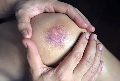 Che cos'è una contusione? La contusione, comunemente conosciuta come livido, è un segno evidente che...