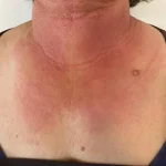 Dermatite fototossica: tutto ciò che devi sapere su sintomi e cause
