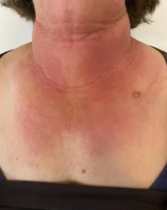 Dermatite fototossica: tutto ciò che devi sapere su sintomi e cause