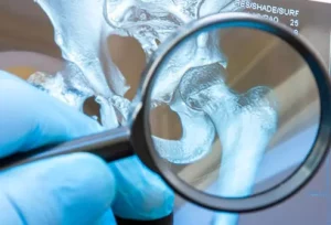 Sintomi, dolore e recupero della lussazione dell’anca: segni e trattamenti essenziali