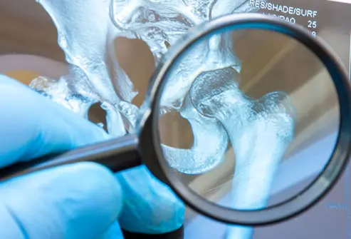 Sintomi, dolore e recupero della lussazione dell’anca: segni e trattamenti essenziali