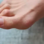 Dita a martello, quali problemi comporta e cosa fare per risolvere il problema