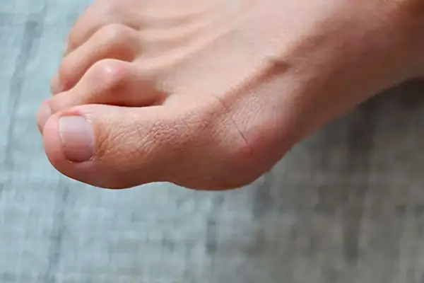 Dita a martello, quali problemi comporta e cosa fare per risolvere il problema