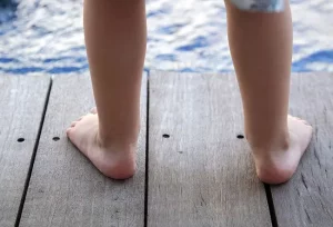 Come riconoscere l’overpronazione: guida rapida per autodiagnosi e trattamento efficace