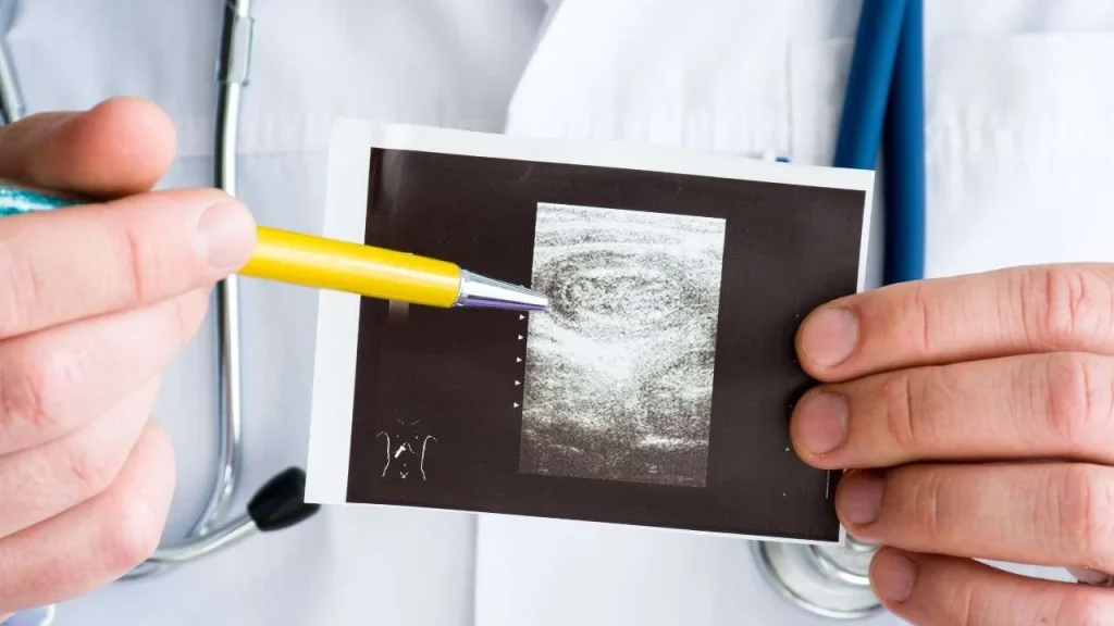 Intussuscezione: trattamento, cause, diagnosi, e sintomi