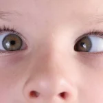 Strabismo: comprendi i sintomi e le opzioni di trattamento per una visione migliore.