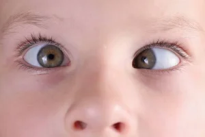 Strabismo: comprendi i sintomi e le opzioni di trattamento per una visione migliore.